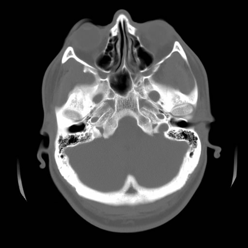 foramen ovale encephalocele